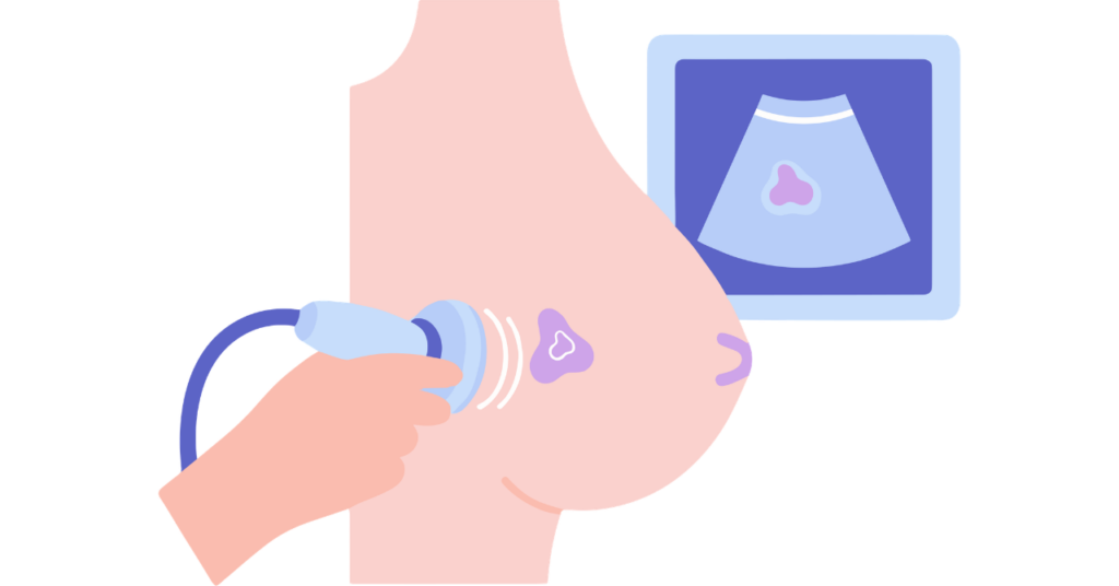 乳房のしこり
