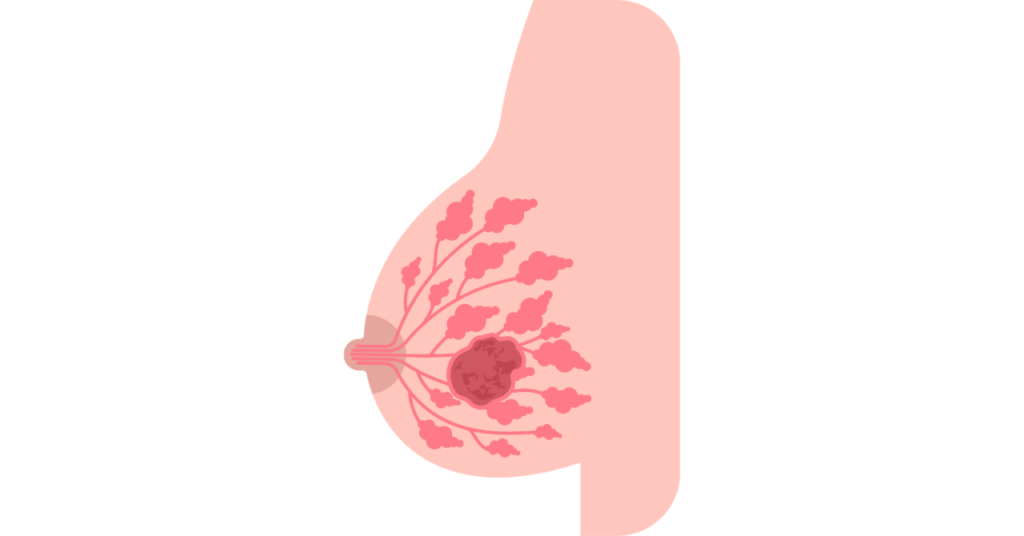 線維腺腫