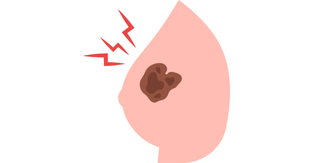 乳がん
